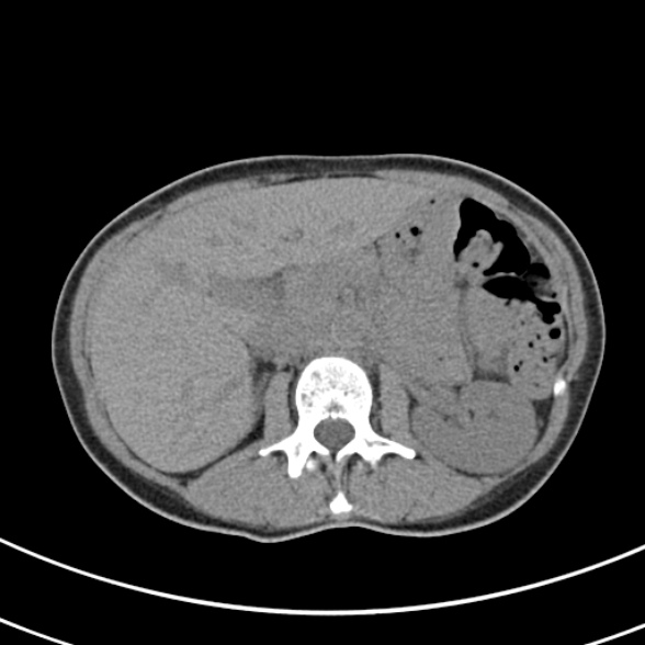 File:Normal multiphase CT liver (Radiopaedia 38026-39996 Axial non-contrast 25).jpg