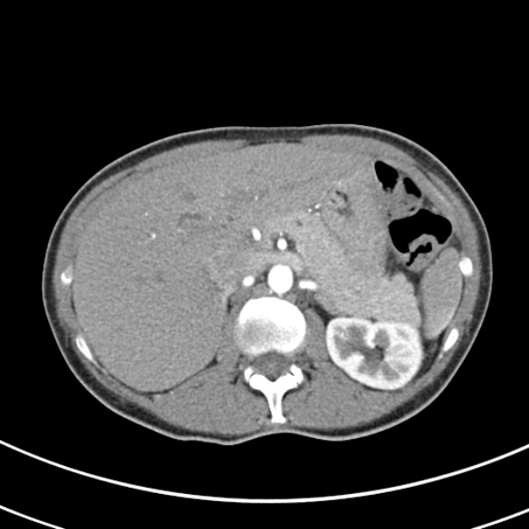 File:Normal multiphase CT liver (Radiopaedia 38026-39996 B 23).jpg