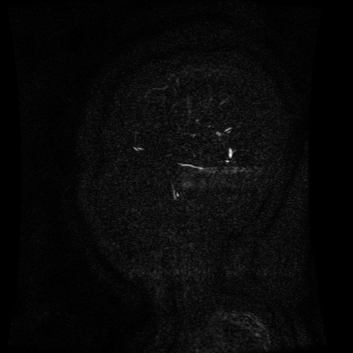 Normal noncontrast MR venography (Radiopaedia 87578-103957 A 162).jpg