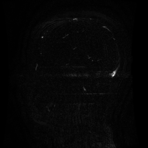 Normal noncontrast MR venography (Radiopaedia 87578-103957 A 95).jpg