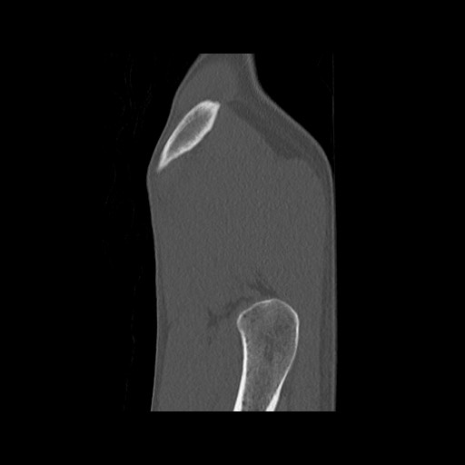 Normal pelvis (Radiopaedia 51473-57238 Sagittal bone window 12).jpg