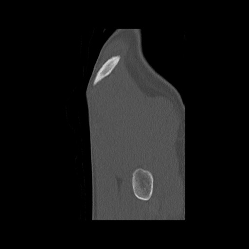 Normal pelvis (Radiopaedia 51473-57238 Sagittal bone window 142).jpg