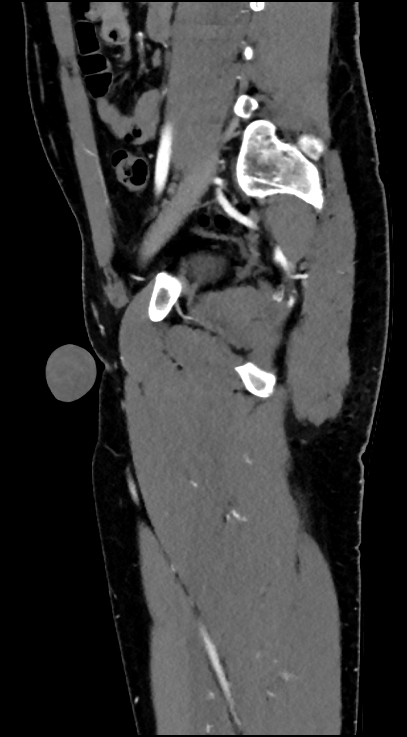 Normal pelvis CT angiogram (Radiopaedia 84966-100481 C 69).jpg