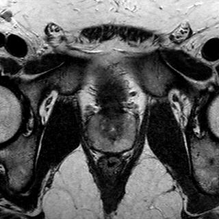 File:Normal prostate (MRI) (Radiopaedia 29986-30535 Axial T2 7).jpg