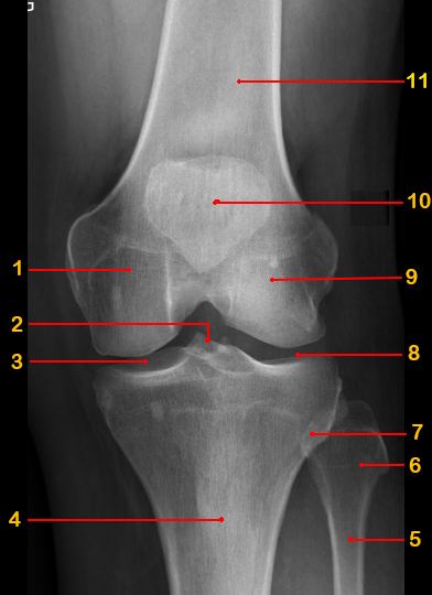 File:Normal radiographic anatomy of the knee (Radiopaedia 42948-46192 AP 1).jpg