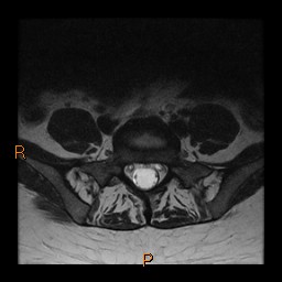 File:Normal spine MRI (Radiopaedia 77323-89408 Axial T2 24).jpg