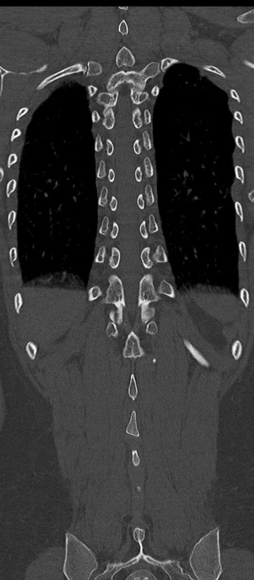 Normal thoracolumbar spine (Radiopaedia 43822-47309 Coronal bone window 71).png