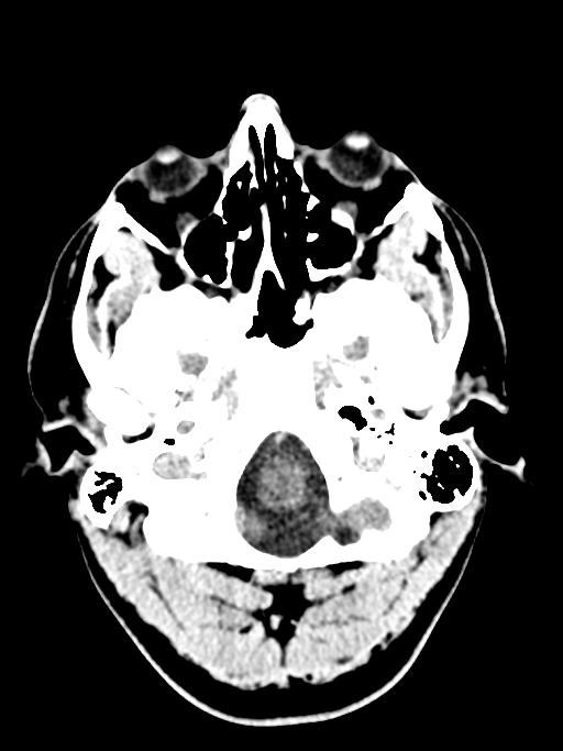 Normal trauma protocol brain and C-spine CT (Radiopaedia 83302-97709 Axial non-contrast 61).jpg