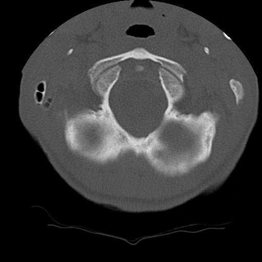 Normal trauma spine imaging (age 16) (Radiopaedia 45335-49358 Axial bone window 6).jpg