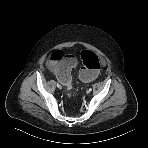 File:Obstructing sigmoid adenocarcinoma (Radiopaedia 58465-65619 A 133).jpg
