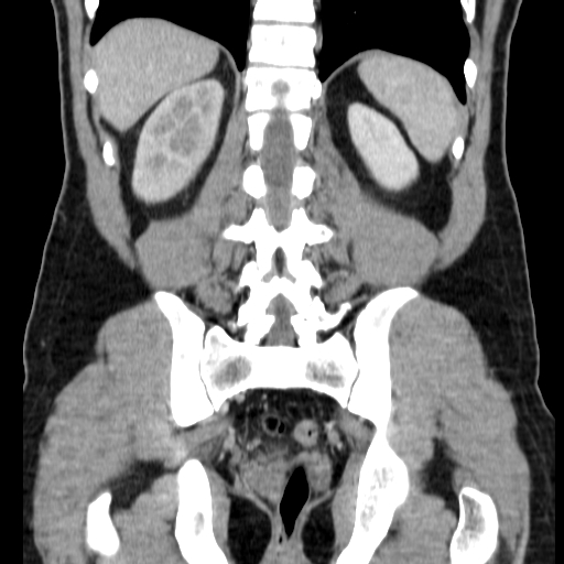 File:Obstructing ureteric calculus (Radiopaedia 18615-18514 C 59).jpg
