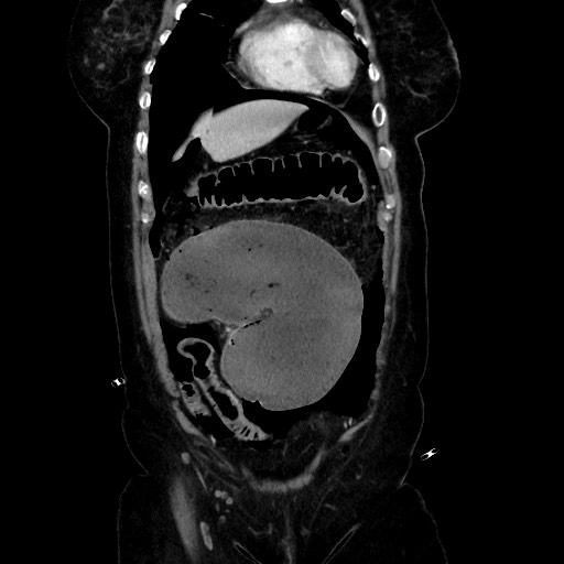 Obstructive distal colonic adenocarcinoma causing cecal perforation (Radiopaedia 86830-102989 C 62).jpg