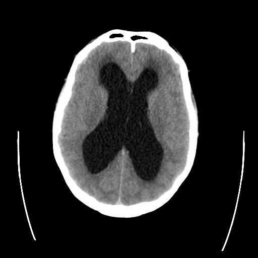 File:Obstructive hydrocephalus (Radiopaedia 30453-31119 Coronal non-contrast 1).jpg