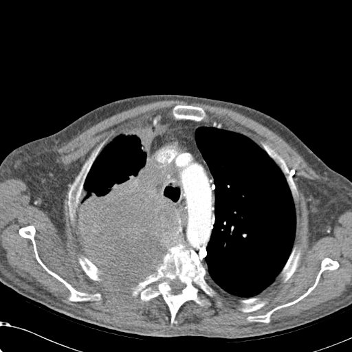 File:Obstructive superior vena cava tumor thrombus (Radiopaedia 28046-28306 A 15).jpg