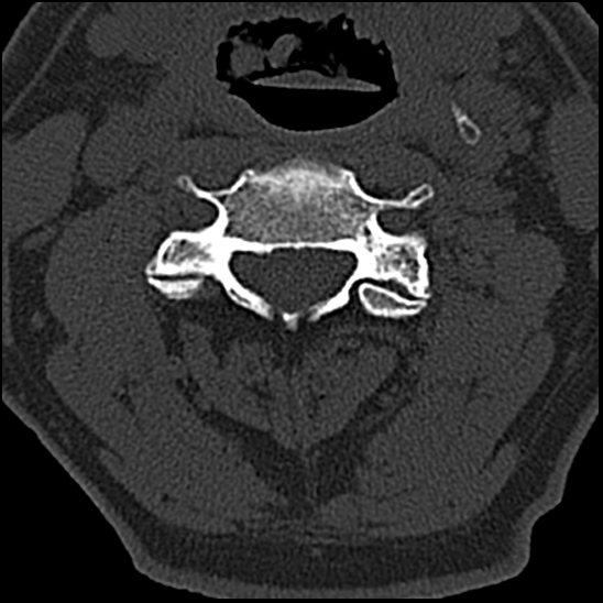 Occipital condyle fracture (type 1) (Radiopaedia 87670-104084 Axial bone window 37).jpg