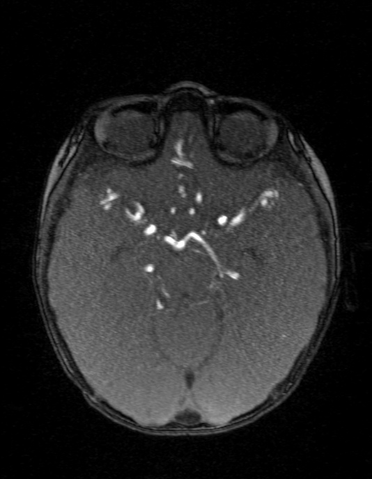Occipital horn syndrome (Radiopaedia 14255-14129 MRA 63).jpg