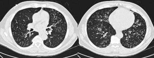 High-resolution computed tomography scan of the thorax