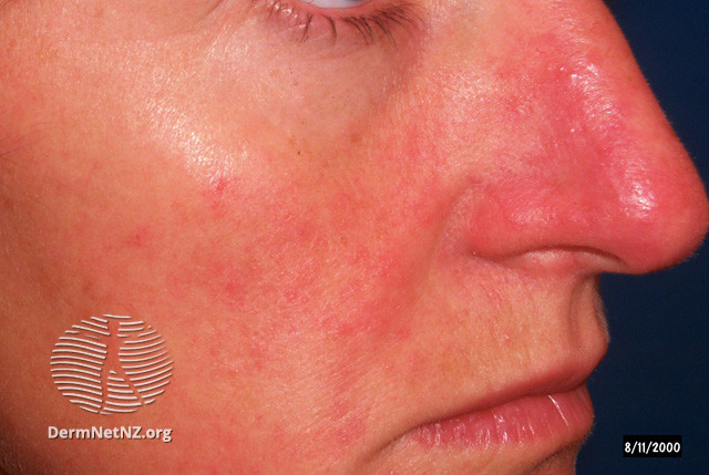 Rosacea (DermNet NZ acne-red-face-3614).jpg