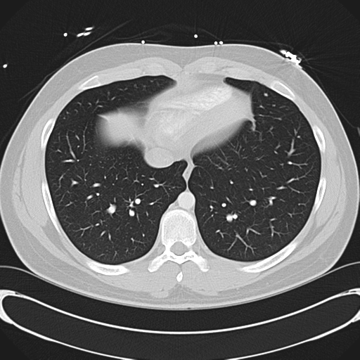 File:'Bovine' aortic arch (Radiopaedia 33554-34637 Axial lung window 46).png