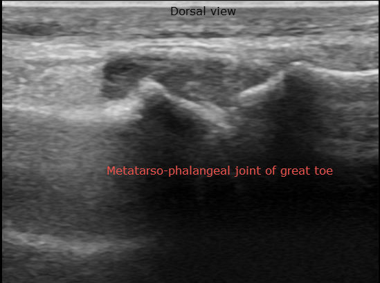 File:1st metatarsophalangeal joint synovitis (Radiopaedia 32235-33185 A 1).jpg