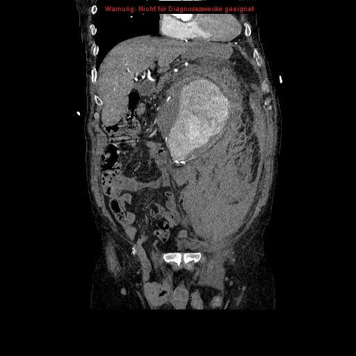 Abdominal aortic aneurysm- extremely large, ruptured (Radiopaedia 19882-19921 Coronal C+ arterial phase 38).jpg