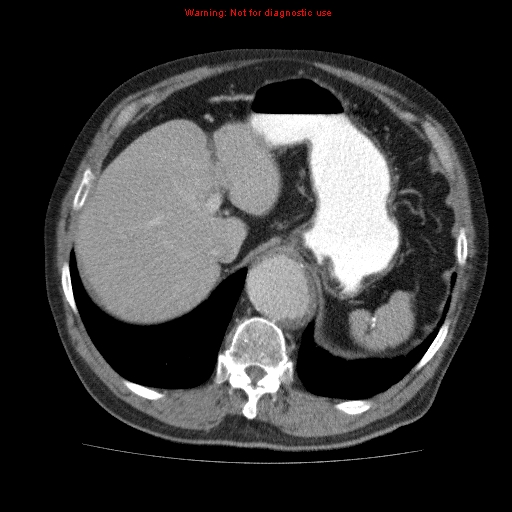 Abdominal aortic aneurysm (Radiopaedia 10122-10660 Axial C+ portal venous phase 14).jpg