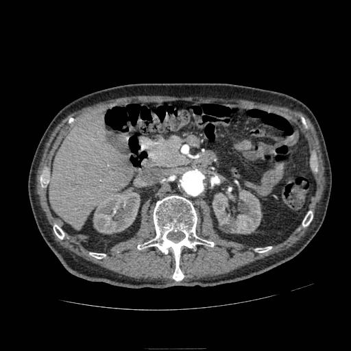 Abdominal aortic aneurysm (Radiopaedia 13341-13340 Axial C+ arterial phase 70).jpg