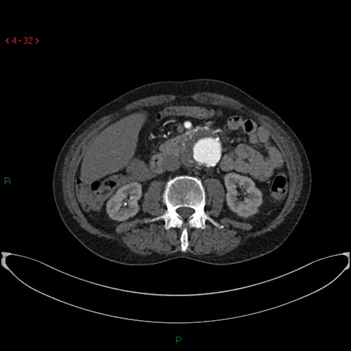 File:Abdominal aortic aneurysm (Radiopaedia 16155-15834 Axial C+ arterial phase 12).jpg