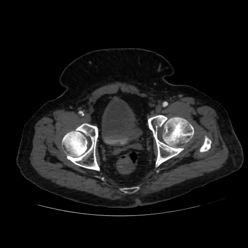 File:Abdominal aortic aneurysm (Radiopaedia 57318-64259 Axial C+ arterial phase 71).jpg