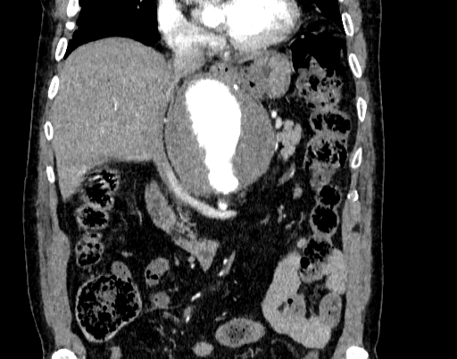 File:Abdominal aortic aneurysm (Radiopaedia 67117-76452 Coronal C+ arterial phase 39).jpg