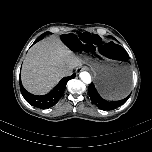 Abdominal aortic aneurysm (Radiopaedia 83581-98689 Axial C+ arterial phase 20).jpg