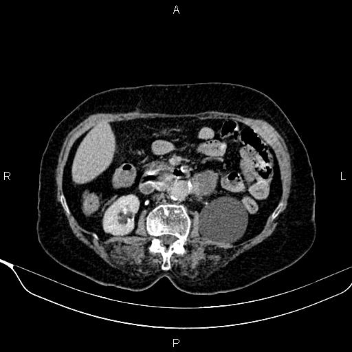Abdominal aortic aneurysm (Radiopaedia 85063-100606 Axial C+ delayed 46).jpg