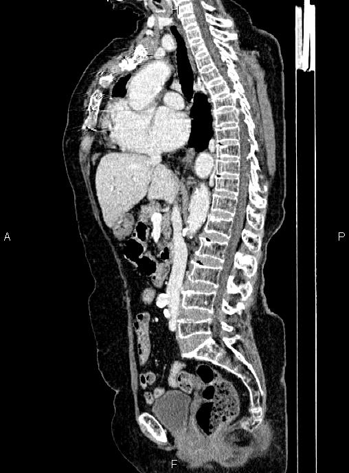 Abdominal aortic aneurysm (Radiopaedia 85063-100606 Sagittal C+ arterial phase 39).jpg