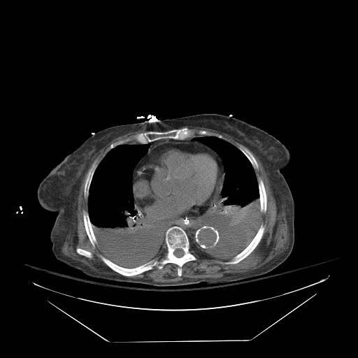 File:Abdominal aortic aneurysm - impending rupture (Radiopaedia 19233-19247 Axial non-contrast 13).jpg