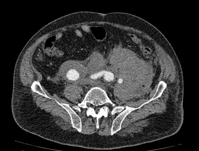 Abdominal aortic aneurysm rupture (Radiopaedia 54179-60362 Axial C+ portal venous phase 11).jpg
