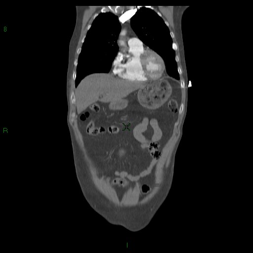 File:Abdominal aortic aneurysm rupture with aortocaval fistula (Radiopaedia 14897-14841 Coronal C+ arterial phase 18).jpg