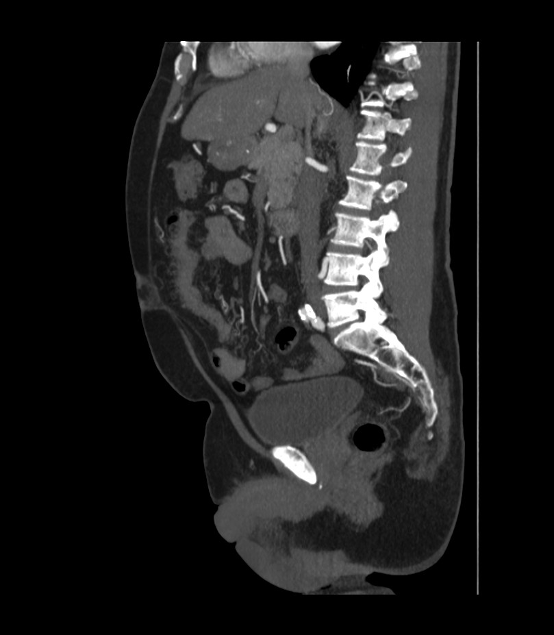 Abdominal aortic aneurysm with thrombus fissuration (Radiopaedia 46218-50618 Sagittal C+ arterial phase 27).jpg