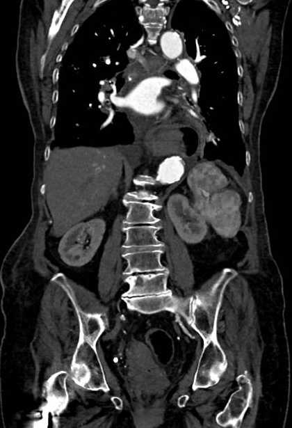 Abdominal aortic aneurysm with thrombus fissuration (Radiopaedia 73192-83919 Coronal C+ arterial phase 55).jpg