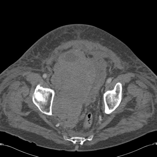 File:Abdominal hematoma (Radiopaedia 33614-34715 Axial C+ portal venous phase 117).png