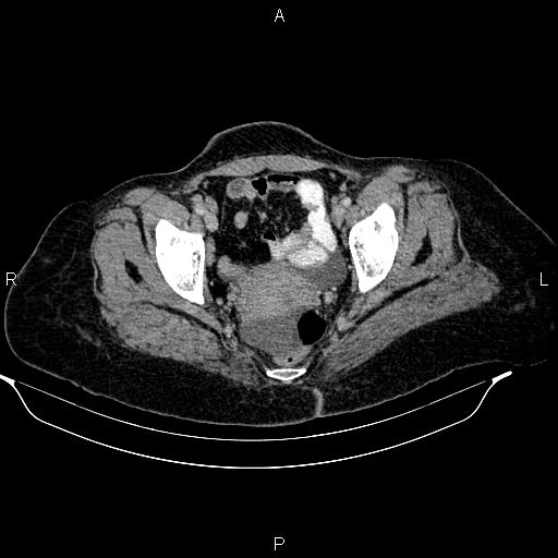 Abdominal lymphoma with sandwich sign (Radiopaedia 84378-99704 Axial C+ portal venous phase 52).jpg