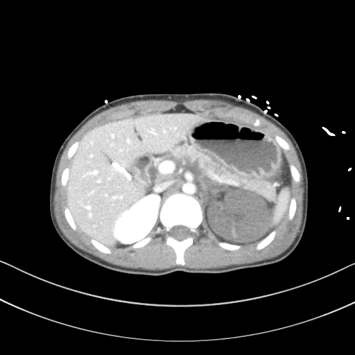 Abdominal multi-trauma - devascularised kidney and liver, spleen and pancreatic lacerations (Radiopaedia 34984-36486 Axial C+ portal venous phase 24).png
