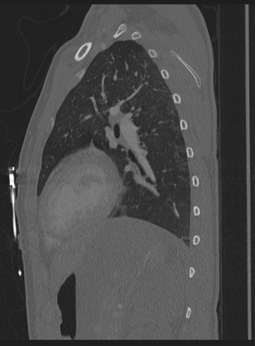 Abdominal multi-trauma - devascularised kidney and liver, spleen and pancreatic lacerations (Radiopaedia 34984-36486 Sagittal bone window 4).png