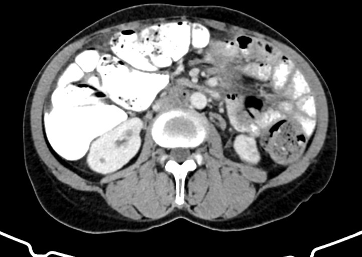 Abdominal wall and retroperitoneal tuberculosis (Radiopaedia 88137-104729 Axial C+ portal venous phase 94).jpg