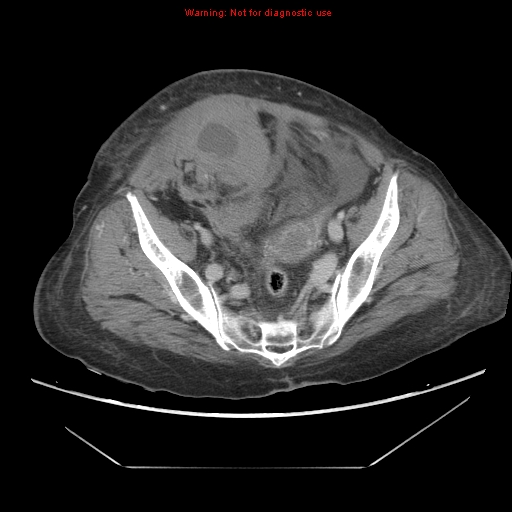 File:Abdominal wall hematoma (Radiopaedia 9427-10112 Axial C+ portal venous phase 88).jpg
