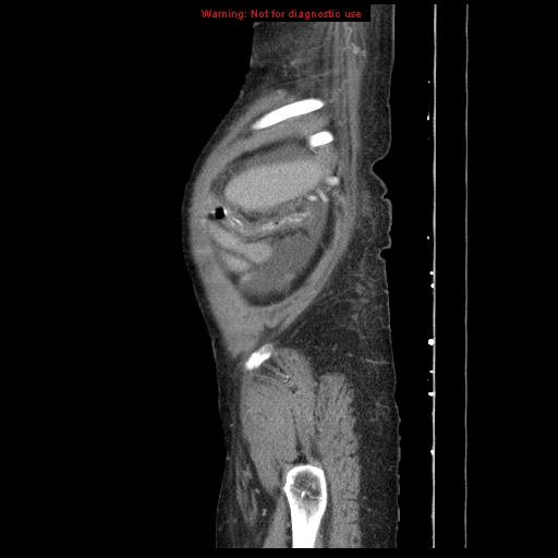 Abdominal wall hematoma (Radiopaedia 9427-10112 Sagittal C+ portal venous phase 12).jpg