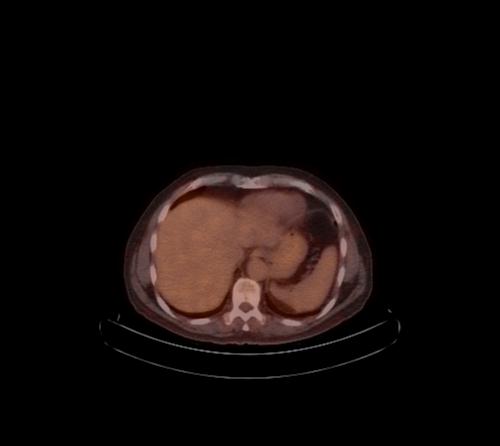 Abdominal wall metastasis from colorectal carcinoma (Radiopaedia 31016-31719 C 92).jpg