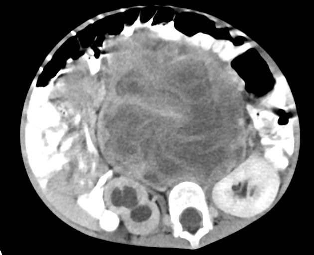 File:Abdominopelvic rhabdomyosarcoma (Radiopaedia 78356-90984 Axial C+ portal venous phase 89).jpg