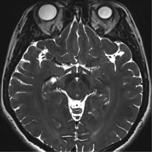 File:Abducens nerve palsy (Radiopaedia 51069-56648 Axial T2 fat sat 75).png