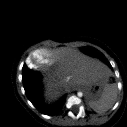 Aberrant left pulmonary artery (pulmonary sling) (Radiopaedia 42323-45435 Axial C+ CTPA 38).jpg