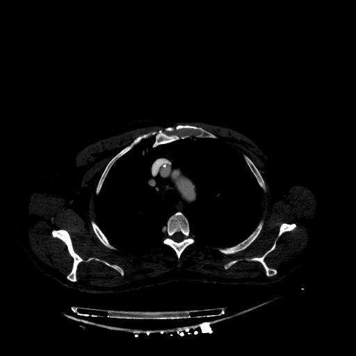 Accesory rib joint (Radiopaedia 71987-82452 Axial bone window 72).jpg